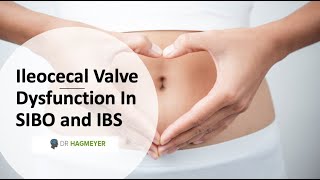 Healing The Ileocecal Valve amp Why Its Important In SIBOIBS [upl. by Tteve]