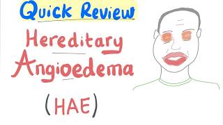 Update of Classification Diagnosis and Treatment of Hereditary Angioedema HAE [upl. by Jaymee]