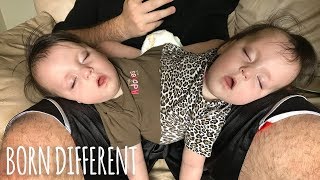 Conjoined Twins Are A Medical Miracle  BORN DIFFERENT [upl. by Knut385]