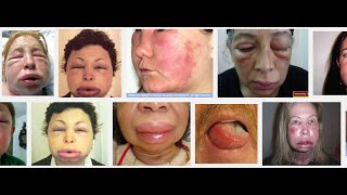 Hereditary Angioedema and Mental Health [upl. by Nimsaj360]