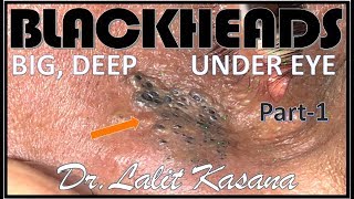 UNDER EYE DEEP BLACKHEADS PART 1 BY DRLALIT KASANA [upl. by Etak558]