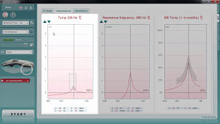 Wideband Tympanometry WBT Tympanograms Tab [upl. by Mencher650]