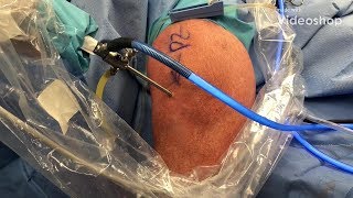 Do I Need A Knee Scope Knee Arthroscopy [upl. by Acimat]