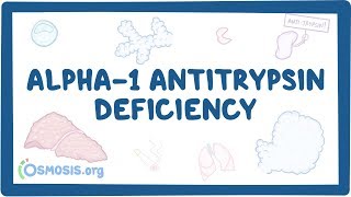 Alpha1 Antitrypsin Deficiency  causes symptoms diagnosis treatment pathology [upl. by Lloyd]